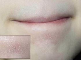 Có cách nào phòng ngừa mụn cám được không?